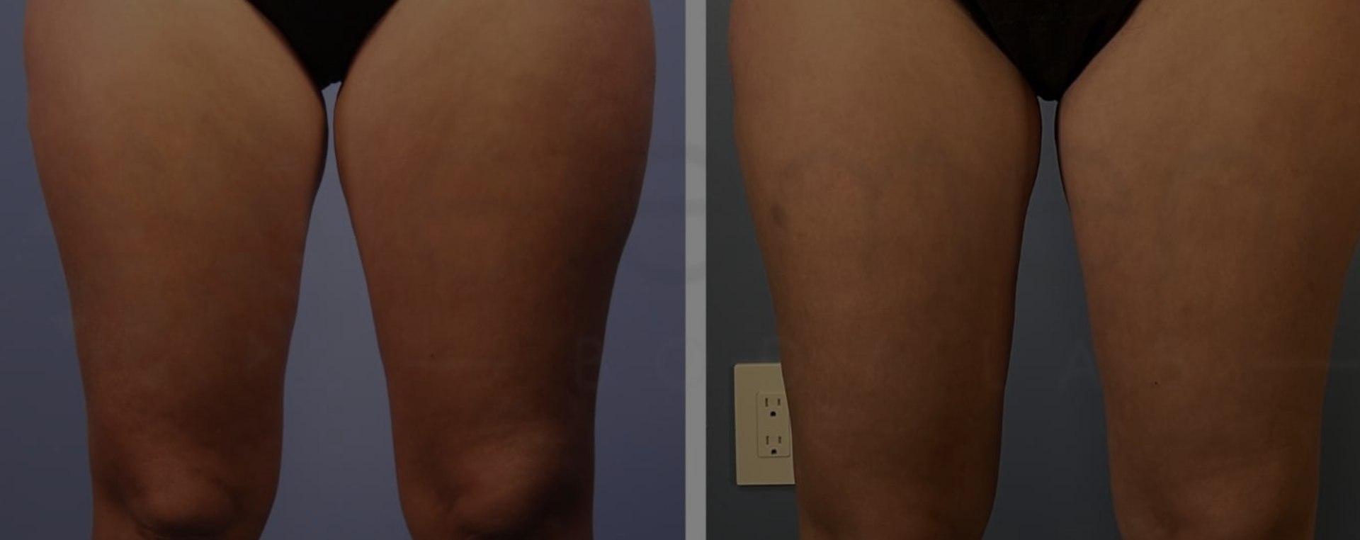Thigh fat reduction